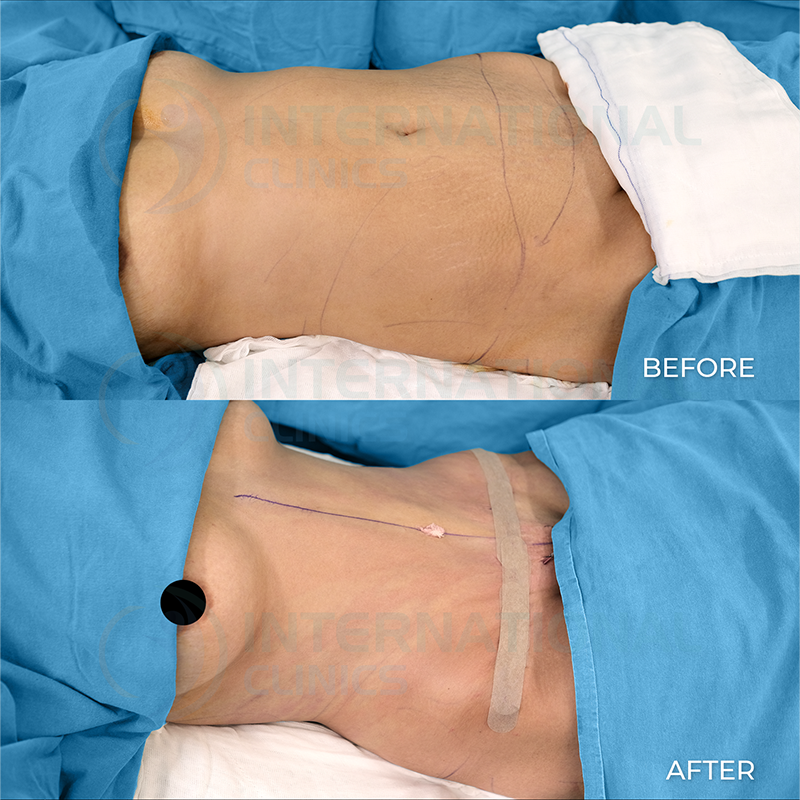 Mini Tummy Tuck before and after images